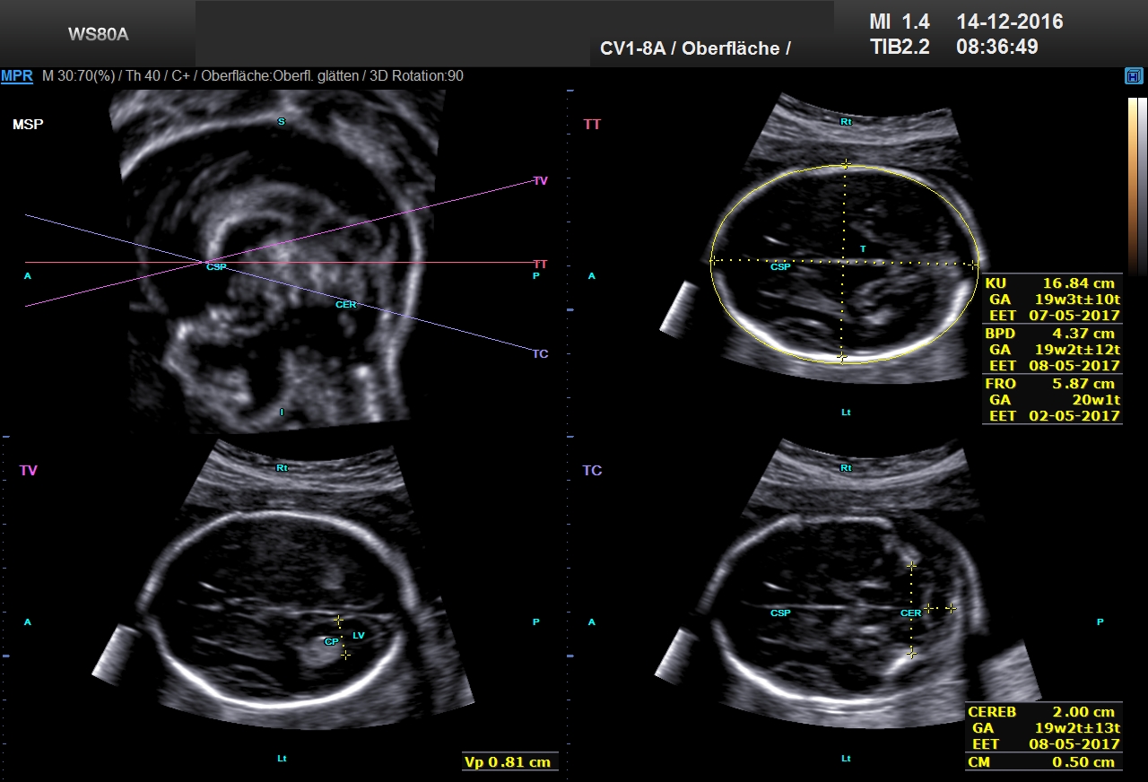 Ultraschall 19SSW 01