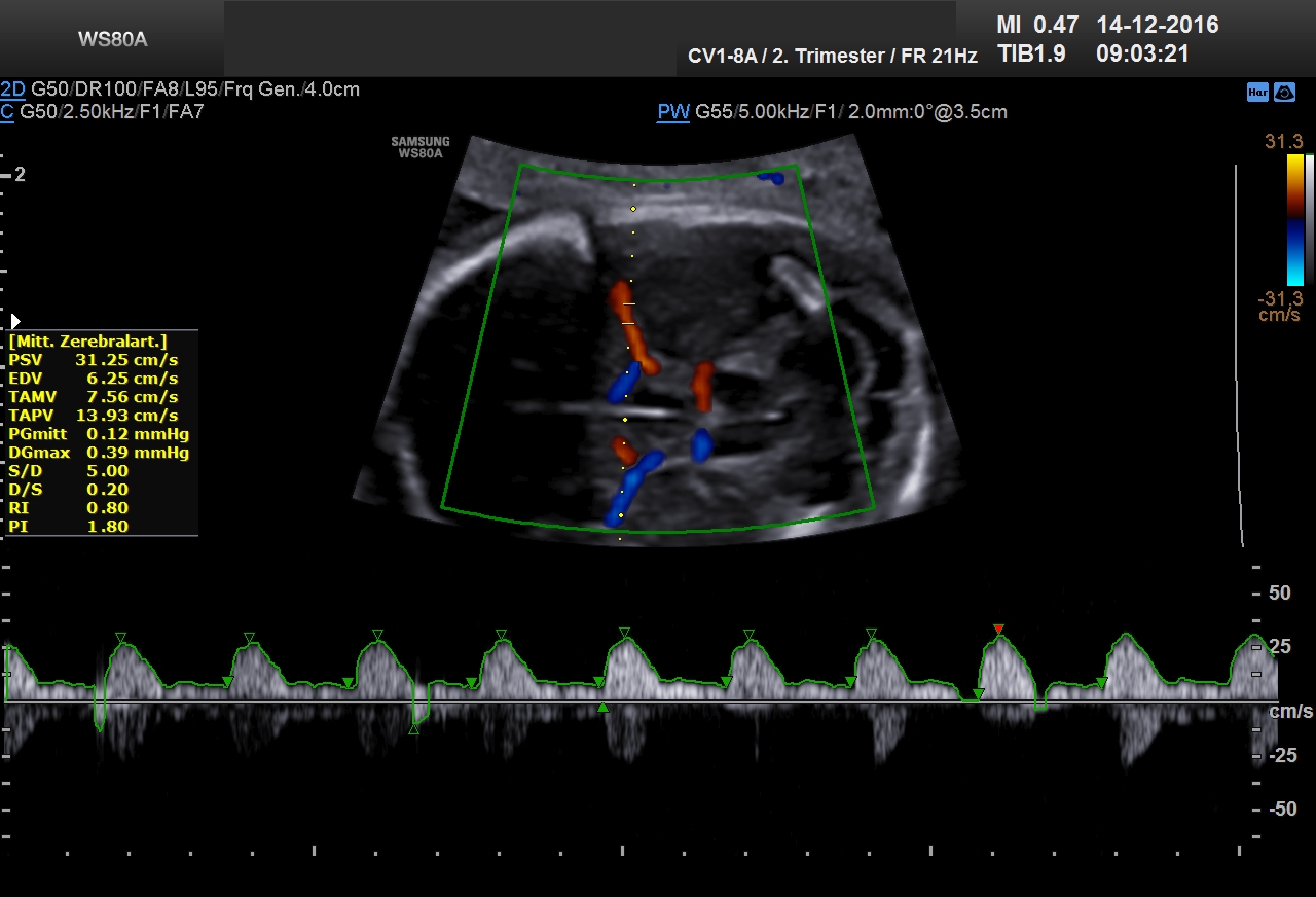 Ultraschall 19SSW 05