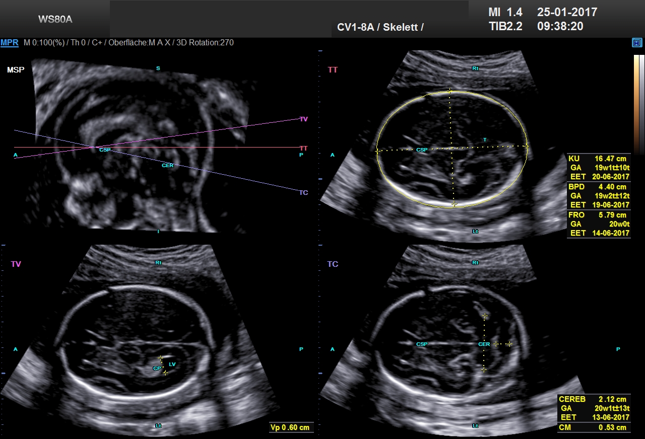 Ultraschall 20SSW 01