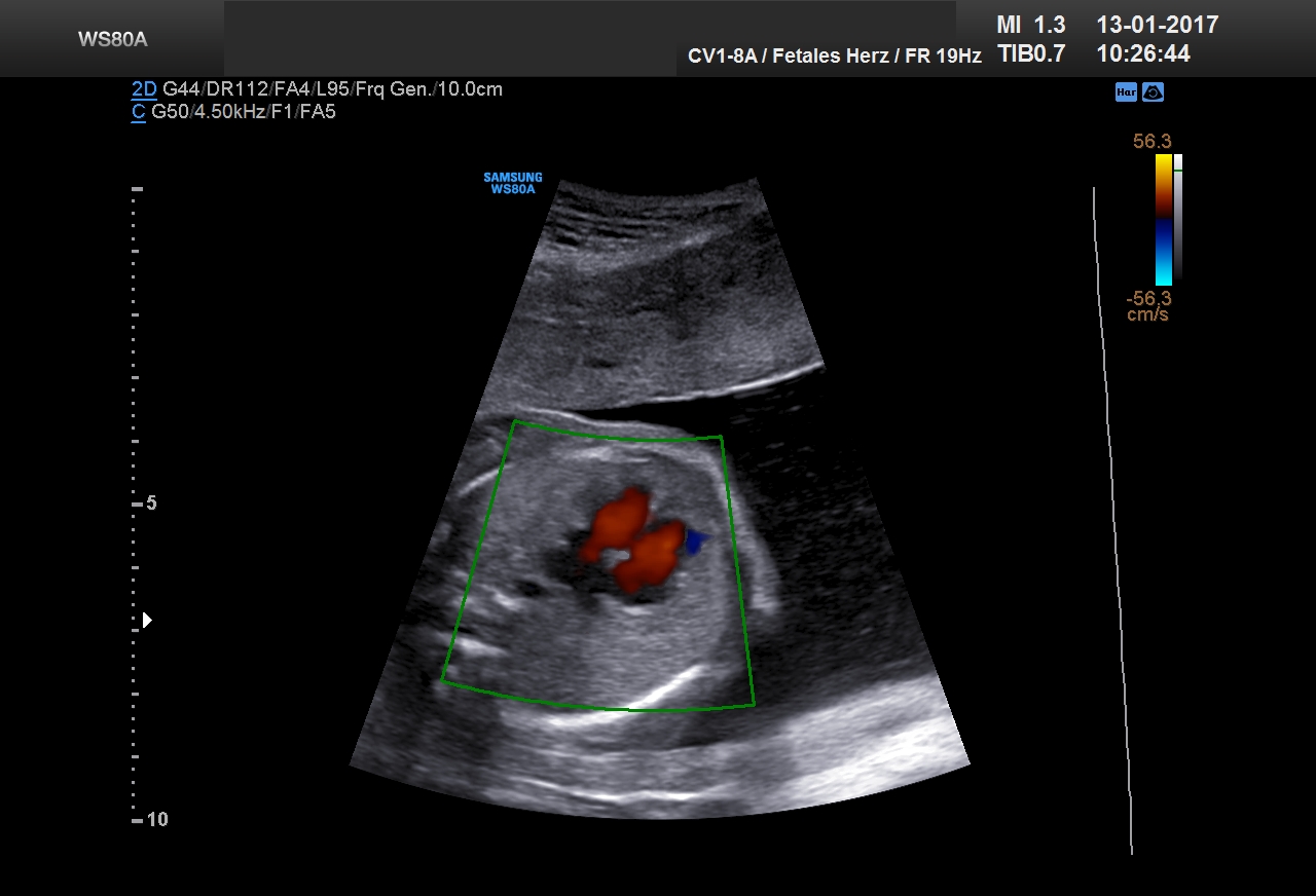 Ultraschall 23SSW 03