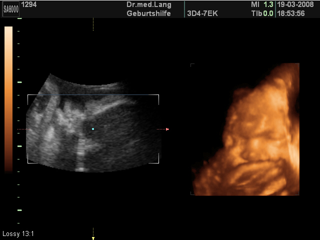 Ultraschall 35SSW 01 3D