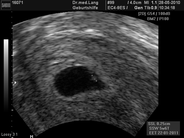 Bild: Ultraschall 6. Schwangerschaftswoche