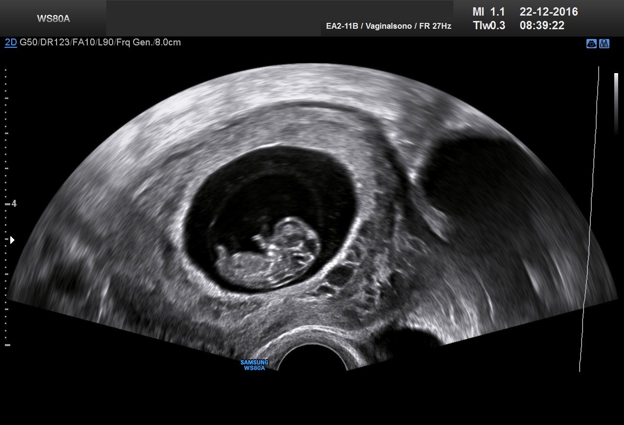 Ultraschall 9SSW 01