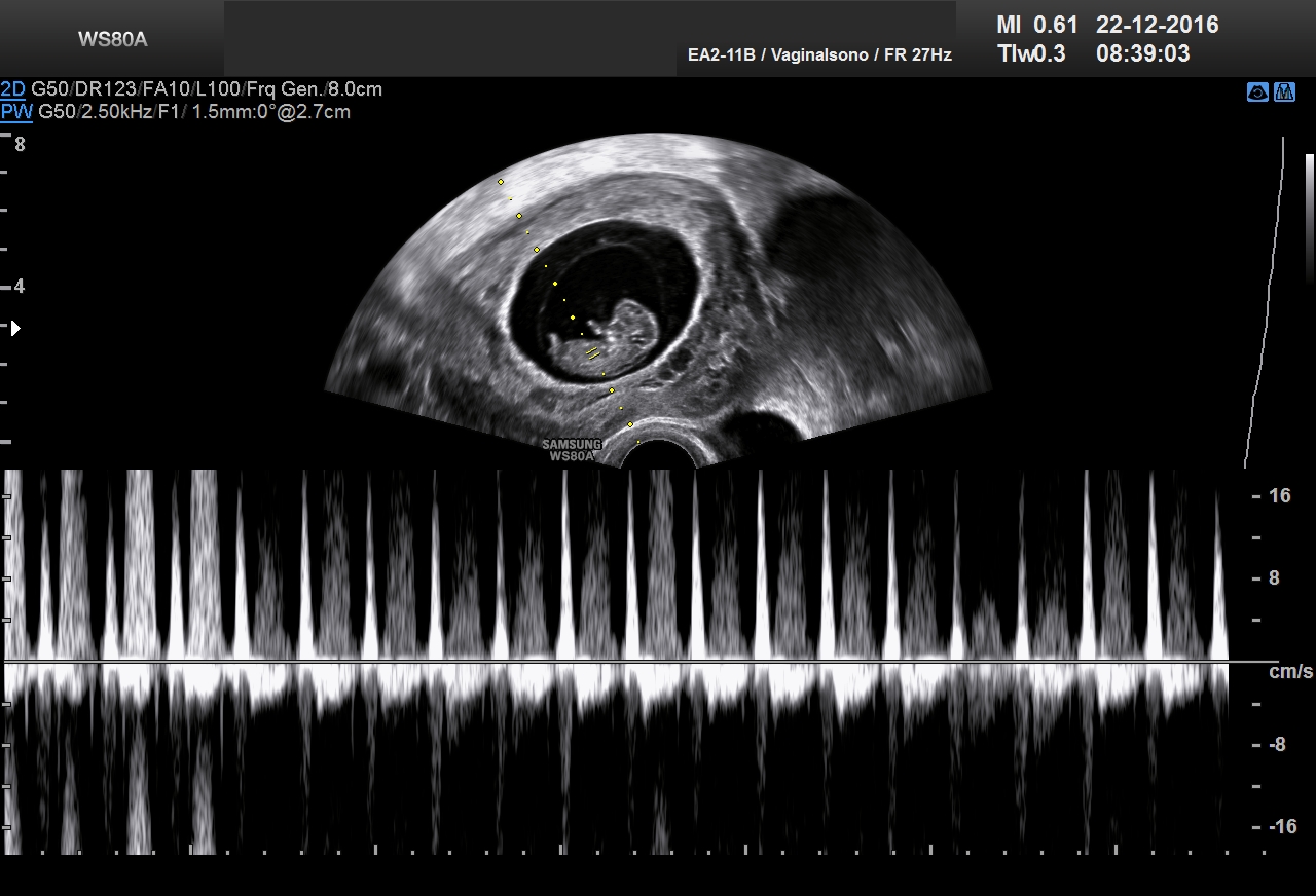 Ultraschall 9SSW 02