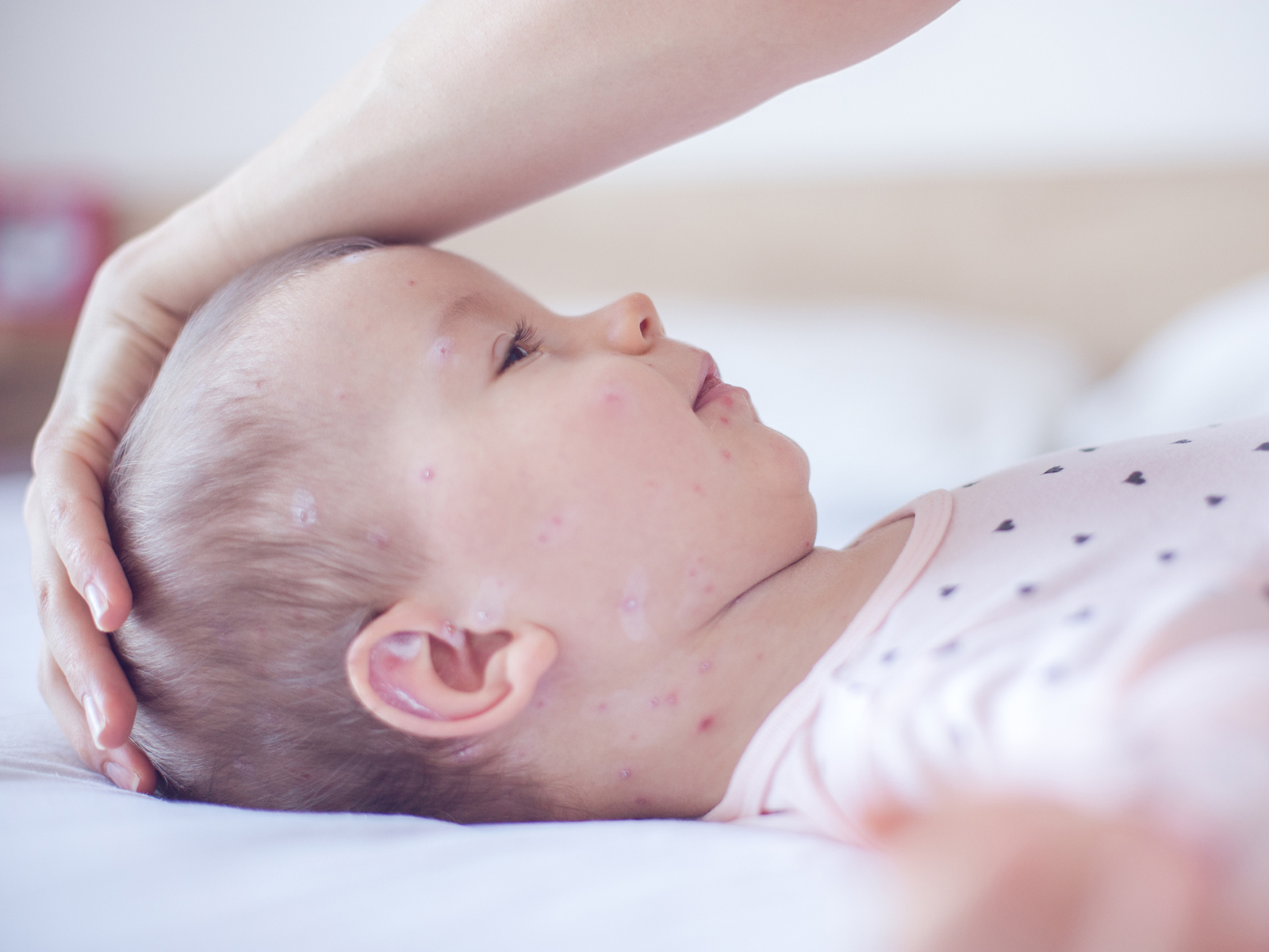 Baby mit Ausschlag auf Bett, Mutter hat Hand auf seinem Kopf