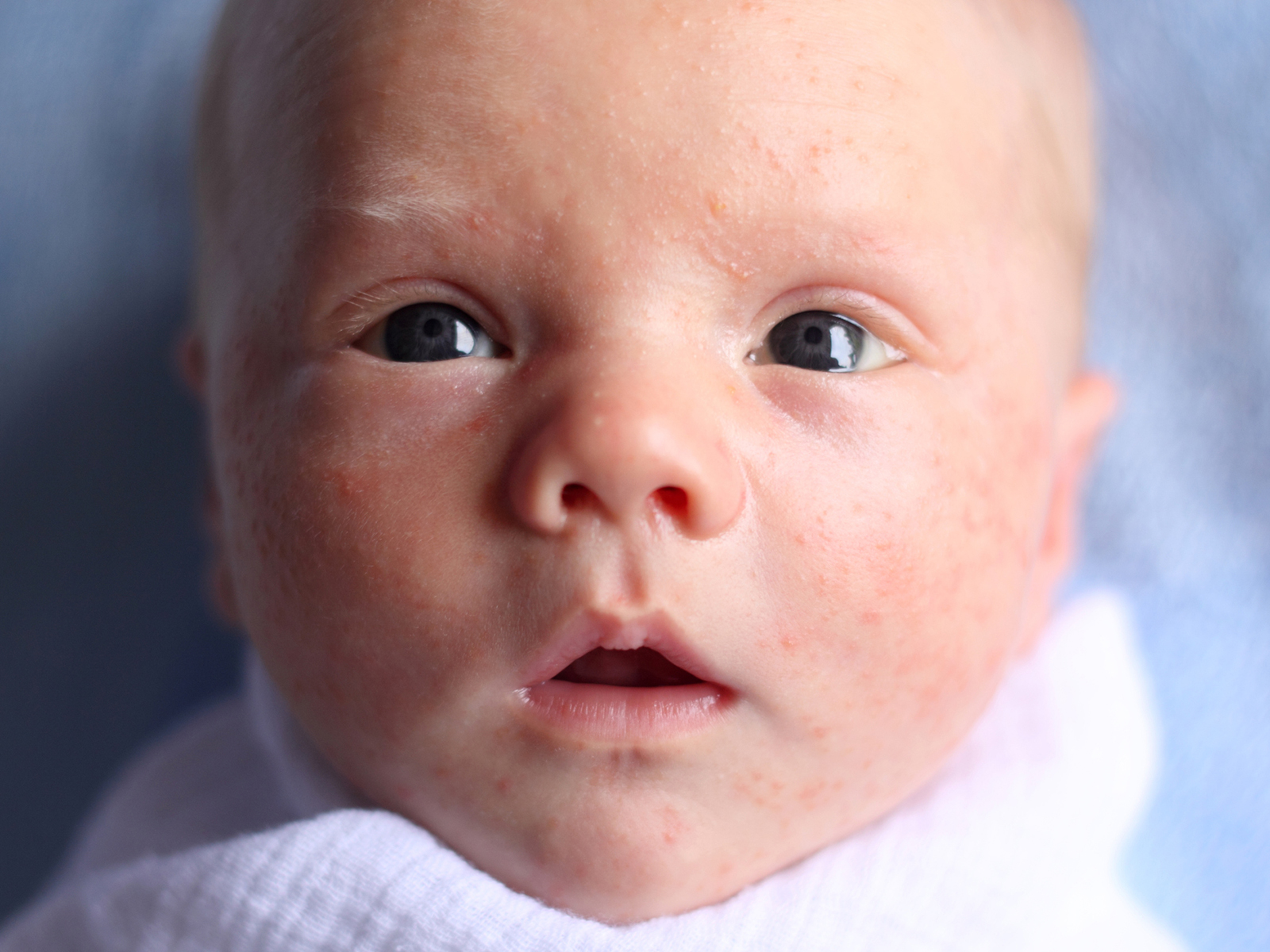 Babygesicht mit Akne