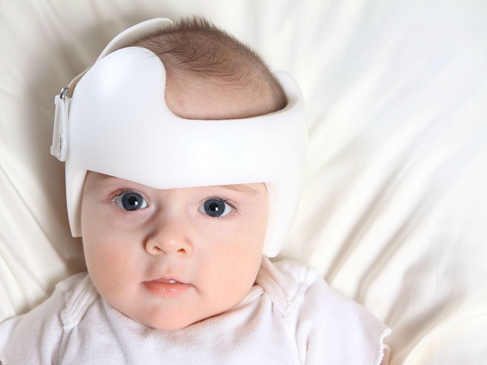Flacher Baby-Schädel: Wie Helmtherapie hilft