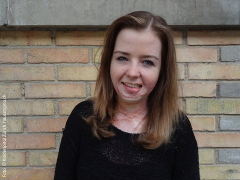 Isabel, ein Mädchen mit Narben im Gesicht und am Hals