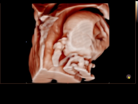 Ultraschall 19SSW 02