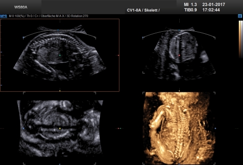 Ultraschall 21SSW 03