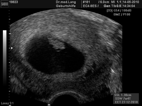 Ultraschall 8SSW 01